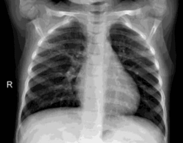Transfer Learning on Chest X-Rays